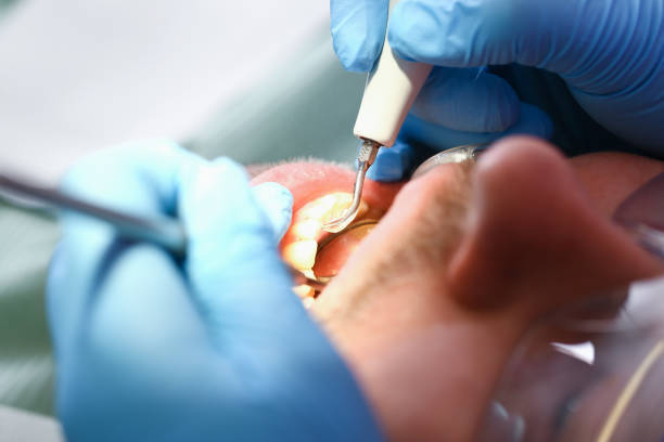 Best Emergency Dental Care for Broken or Chipped Teeth in Dewitt, MI