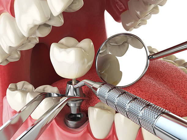 Best Emergency Treatment for Dental Infections or Abscesses in Dewitt, MI